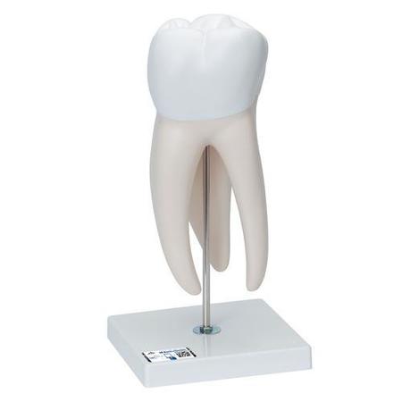 3B SCIENTIFIC Giant Molar w. Dental Caries, 6 part - w/ 3B Smart Anatomy 1013215